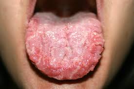 Lengua Blanca Causas Y Soluciones Mejor Con Salud