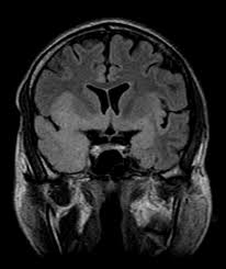 The clinical syndrome is often characterized by the rapid onset of fever, headache, seizures, focal neurologic signs, and impaired consciousness 1. Pin On Med Stuff
