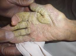 Image result for scabies transmission