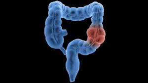 Are some people more at risk? Colon And Rectal Cancer Can Go Missed In Younger Adults Study Shows Cnn