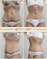 This type of surgery adds a vertical incision for patients who need a great deal of extra skin removed in order to restore their hips and curves. Tummy Workofart This Patient Had A Fleur De Lis Tummy Tuck She Had Lost Over 60kg Yet Despite Being Fit And H Tummy Tucks Excess Skin Cosmetic Surgery