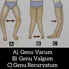 Image result for Genu Varum