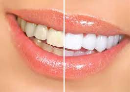 Teeth Whitening Teeth Whitening Cost Teeth Scaling And Polishing