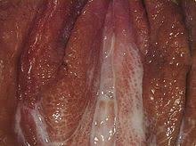 Die eierstöcke (ovarien) sind mit kleinen, flüssigkeitsgefüllten bläschen übersät, den sogenannten follikeln. Vagina Wikipedia
