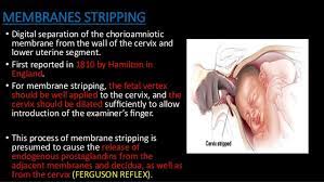 Induction Of Labor