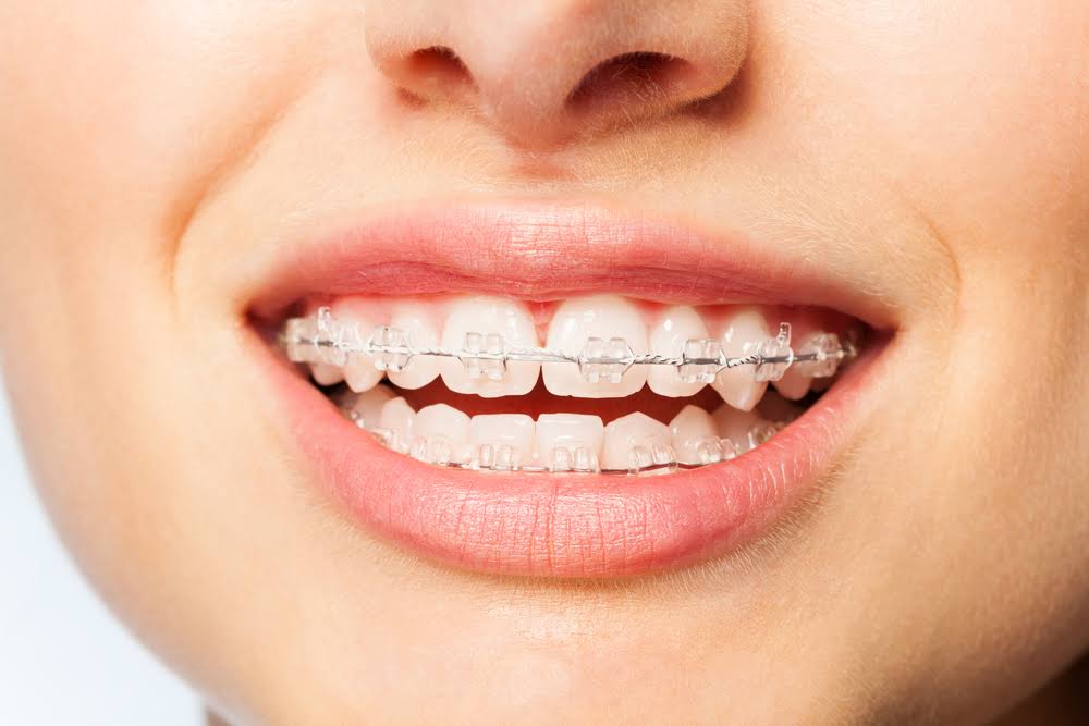 Ceramic Braces product image