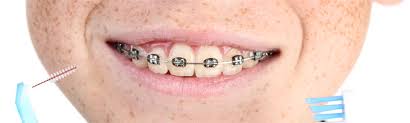 Besser ist die wahl der zahnspange, wenn das milchgebiss komplett durch die dauerhaften zähne ersetzt ist. Zahnzusatzversicherung Fur Kinder Bei Zahnspange Und Kieferorthopadie