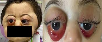 Image result for Proptosis