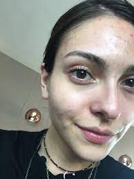 Anna sarelly es una famosa youtuber enfocada al maquillaje y la moda muy famosa por los increíbles looks que logra. Anna Sarelly Cornejo On Twitter Tener Acne O Brotes Alguna Vez En Tu Vida Es Normal No Sufras Ve Al Derma Y Ellos Saben Que Hacer Para Quitarlo Ya Grabe Un