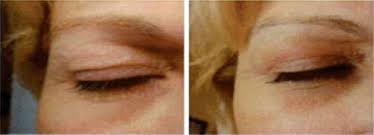 We did not find results for: Plasmage Lyon Medecine Esthetique Lyon Blepharoplastie Sans Chirurgie