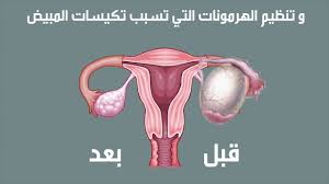 قائمة بأمراض النساء الأكثر شيوعا في النساء وأعراضها مقالات