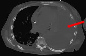 May 25, 2021 · the aetiology of the pleural effusion determines other signs and symptoms. Cureus Spontaneous Loculated And Massive Hemothorax An Uncommon Complication Of Warfarin Therapy
