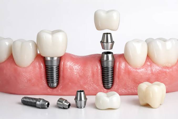 Dental Implants in Mumbai | The Dental Arch