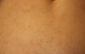 Although it's possible to get hantavirus infection from a mouse or rat bite, such infections are rare. Ausschlag Praxisblattle