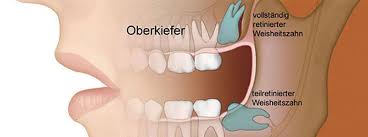 Weisheitszähne: OP-Dauer, Ablauf & Risiken | dentolo