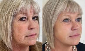 𝐕𝐈𝐕𝐎-𝐋𝐈𝐅𝐓! 🔥❤️✨ (Also known as endolifting) Check out these insane  results from our vivo-lift treatment how incredible dose she look!🤩 This  has truly become one of our favourite treatments without fail, every