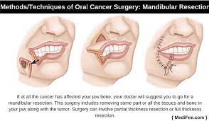 A lump or thickening in the cheek. Oral Cancer Treatment Surgery And Related Risk Factors