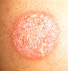 Consultez toujours en cas de doute. Mycose Causes Symptomes Traitement Teleconsultation Dermatologue