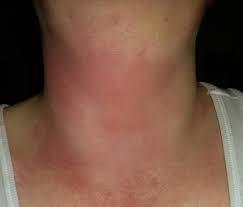 Plotzlicher Ausschlag Woher Konnte Er Kommen Haut Dermatologie