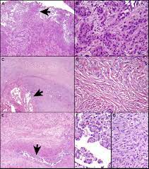 Check spelling or type a new query. Morphologic Features Of Malignant Mesothelioma A B Epithelioid Download Scientific Diagram