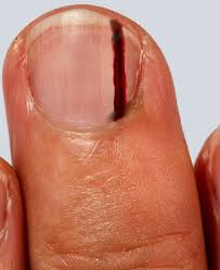 What does melanoma under the nail look like? Figure Subungual Melanoma Of The Middle Finger Contributed By S Bhimji Md Statpearls Ncbi Bookshelf
