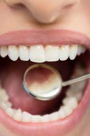 Maybe you would like to learn more about one of these? How To Get Rid Of Cavities Home Remedies Prevention