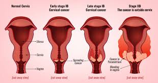Routine screening intervals for asymptomatic individuals who do not require surveillance Cervical Cancer Stages Prof Andreas Obermair Professor Andreas Obermair