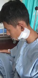 Limfoma ialah sejenis kanser daripada limfosit (salah satu daripada jenis sel darah putih). Keputusan Pembedahan Kelenjar Pertama Negatif Kanser Tapi Pelajar Ini Akan Dibedah Lagi Keadaan Ini Mengganggu Persiapan Spm Viral Mstar