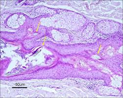 Pili multigemini, also known as compound hairs, is a malformation characterized by the presence of bifurcated or an extracted pili multigemini with three distinct hairs growing from the same source. Extensive Pili Multigemini Over The Back Abstract Europe Pmc