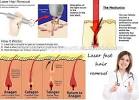 Laser Hair Removal