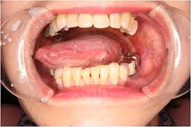 Image result for spinocellular carcinoma of the oral cavity