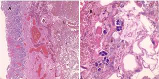 And groups of these characteristic groupings occur as a result of variations in the reproduction process in bacteria. Full Text Sarcina Ventriculi A Case Report Of Gastric Perforation In A 85 Year Old Male With History Of Colon Cancer Journal Of Case Reports And Images In Pathology