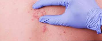 Mötet sker via videosamtal eller meddelanden via din telefon, läsplatta och dator. Herpes Zoster Halsoinformation Medicinska Tips Och Anvandbar Halsoinformation