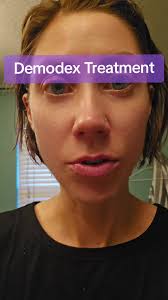 These are great products to combat demodex. there are many others but this  is a god place to start. Along with a healthy, clean diet & Immune boosting  supplements. #demodex #demodexmites #mites #skin ...