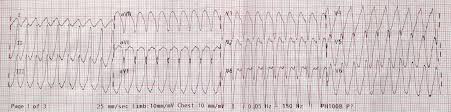 Stands for special vehicle team, from ford. Vt Vs Svt With Aberrancy Resus