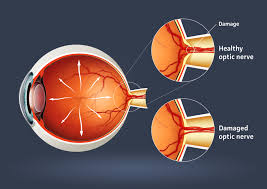 Image result for Glaucoma