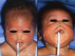 Airway Management in an Infant with Alobar Holoprosencephaly and  Cebocephaly Associated with Maternal Diabetes Mellitus