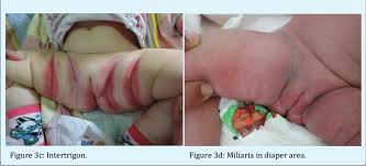 Image result for diaper dermatitis