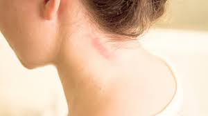 How to Treat a First-Degree, Minor Burn | Newswise