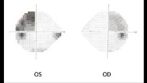 Image result for Visual Field Deficit