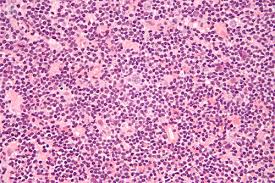 Linfoma é um termo genérico para classificar os cancros que se desenvolvem nos linfócitos e consequentemente, nos orgão do sistema. Enfermedad De Hodgkin Que Es Sintomas Causas Prevencion Y Tratamiento Top Doctors
