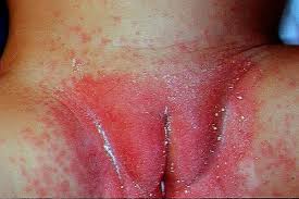 Image result for Intertrigo under breasts