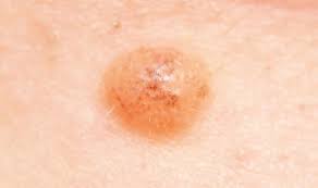 Lung cancer is a serious illness which none of us wish to face. Skin Cancer Does Your Mole Look Like This Pictures Reveal A Person S Cancer Risk Express Co Uk