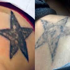Our tattoo removal professionals are friendly, patient and trained to use the most up to date laser tattoo removal. Laser Tattoo Removal In Houston Tx Tattoo Removal In Houston Txesta Kronberg Md
