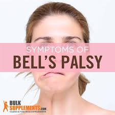 Signs and symptoms of bell's palsy. Bell S Palsy Symptoms Causes Treatment Bulksupplements Com