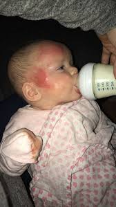 The rash on his cheek was getting drier and redder by the day. This Baby S Terrible Eczema Was Cured By A 4 50 Cream Cambridgeshire Live