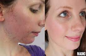 Dit kan zowel een positieve als negatieve invloed hebben op je huid. Hormonale Acne Wat Is Het En Welke Producten Helpen Echt