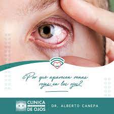 Las Venas Rojas En Los Ojos Son Facilmente Visibles Sobre La Conjuntiva Blanca Por Tanto Con El Solo Hecho De Que Aumente La Irrigacion De Sangre En Los Ojos Por Cualquier Causa
