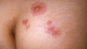 Most men who get hpv never develop symptoms and the infection usually goes away completely by itself. Genital Warts And Hpv In Men