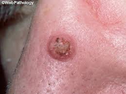 Skin cancer is one of the most common types of cancer. Webpathology Com A Collection Of Surgical Pathology Images